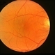 Normal eye Normal eye